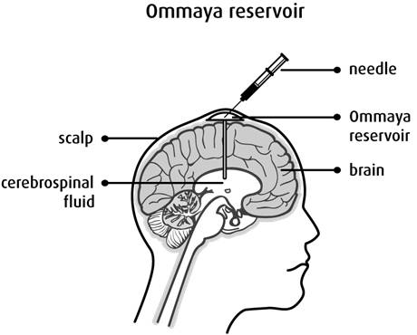 Ommaya
